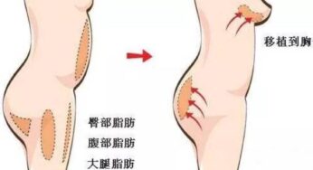 自体脂肪隆胸后术后护理要点和注意事项