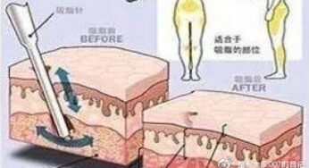 腰腹部吸脂后会不会反弹？