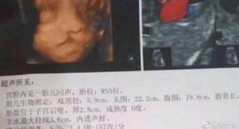 做B超看见胎儿做鬼脸 医生却说孩子不能留