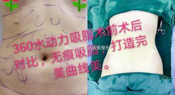 吸脂术后还会反弹吗？