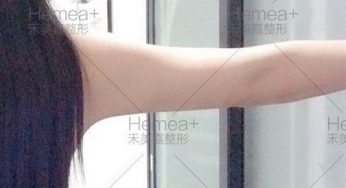 超S轮廓线艺术体雕，让你夏季轻松拥有美人臂