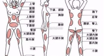 大腿部吸脂后能不能马上走路？