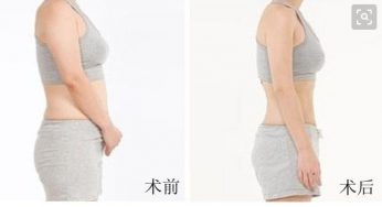 腰腹和大腿可以同时进行吸脂吗?