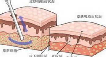 吸脂塑型——原来是这样