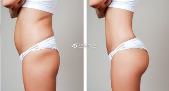 做完吸脂后皮肤变松弛了还会变回来吗？