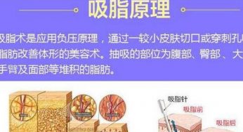 共振吸脂和水动力吸脂哪个好？优缺点分析，看你适合哪个！