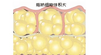 喵姐讲科普：吸脂后会不会反弹呢？做吸脂需要注意哪些呢？