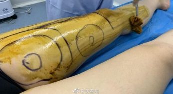 全身吸脂术后大家关心的8个问题，吸脂术前功课