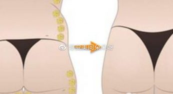 做自体脂肪丰臀后需要趴着睡觉吗