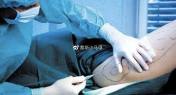小马甲我想问问吸/抽脂能让人暴瘦吗？吸/抽脂会反弹吗？