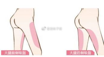 大腿吸脂术后如何护理呢？多久可以完全恢复呢？