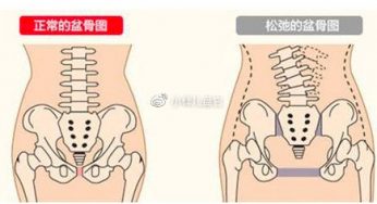 吸脂能改善妈妈臀吗，如何做才能更好地塑造完美臀型？