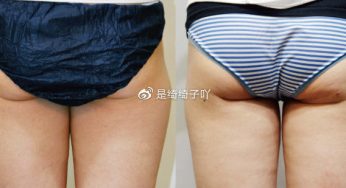 屁股抽脂的恢复期有多长？